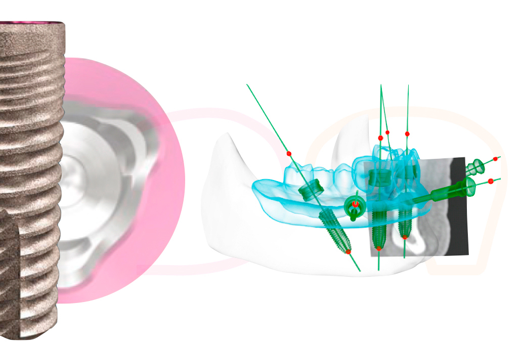 implantes-dentales.jpg